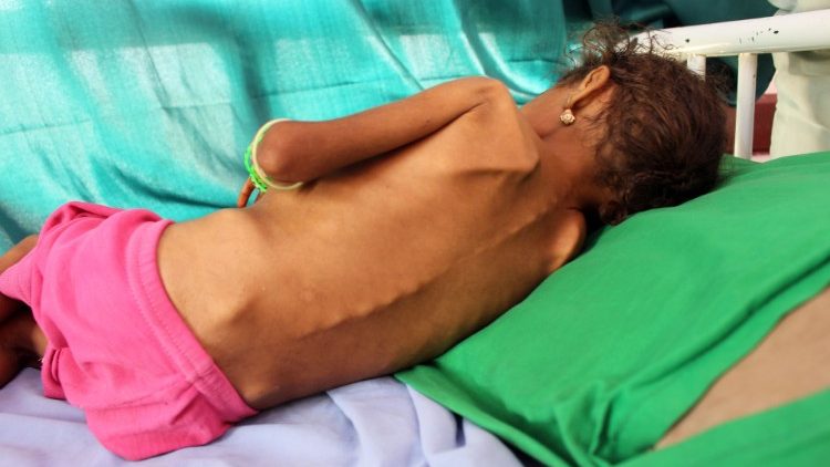 Trẻ em suy dinh dương tại Yemen  (AFP or licensors)